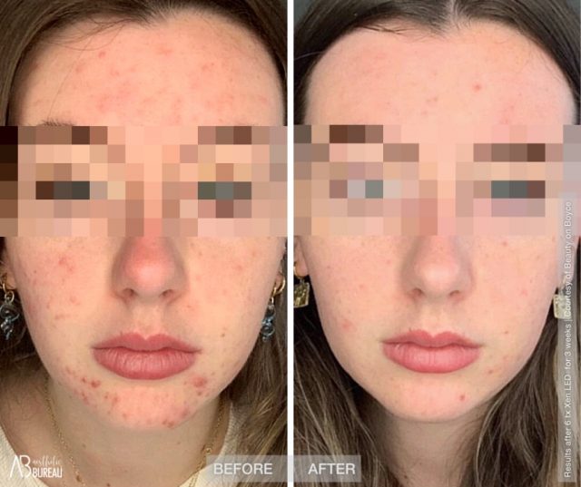 Before-After-Beauty-Boyce-Acne-640x537