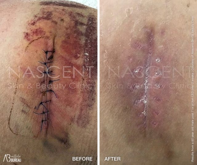 Before-After-Nascent-Wound-Healing-Xen-1-640x536