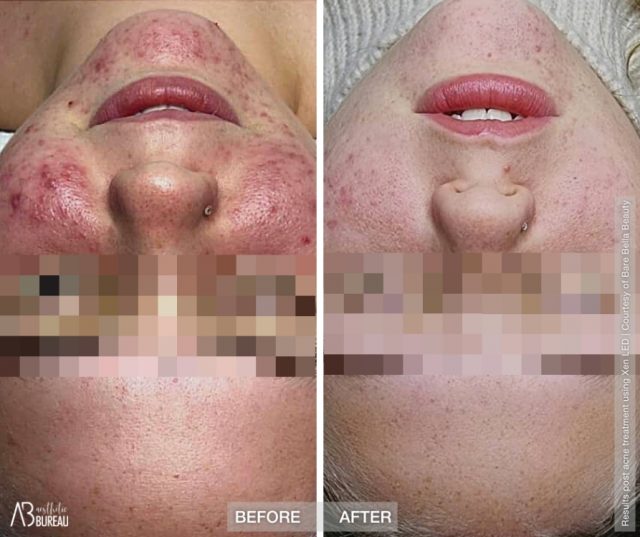 Before-after-Bare-Bella-Acne-Xen-640x537