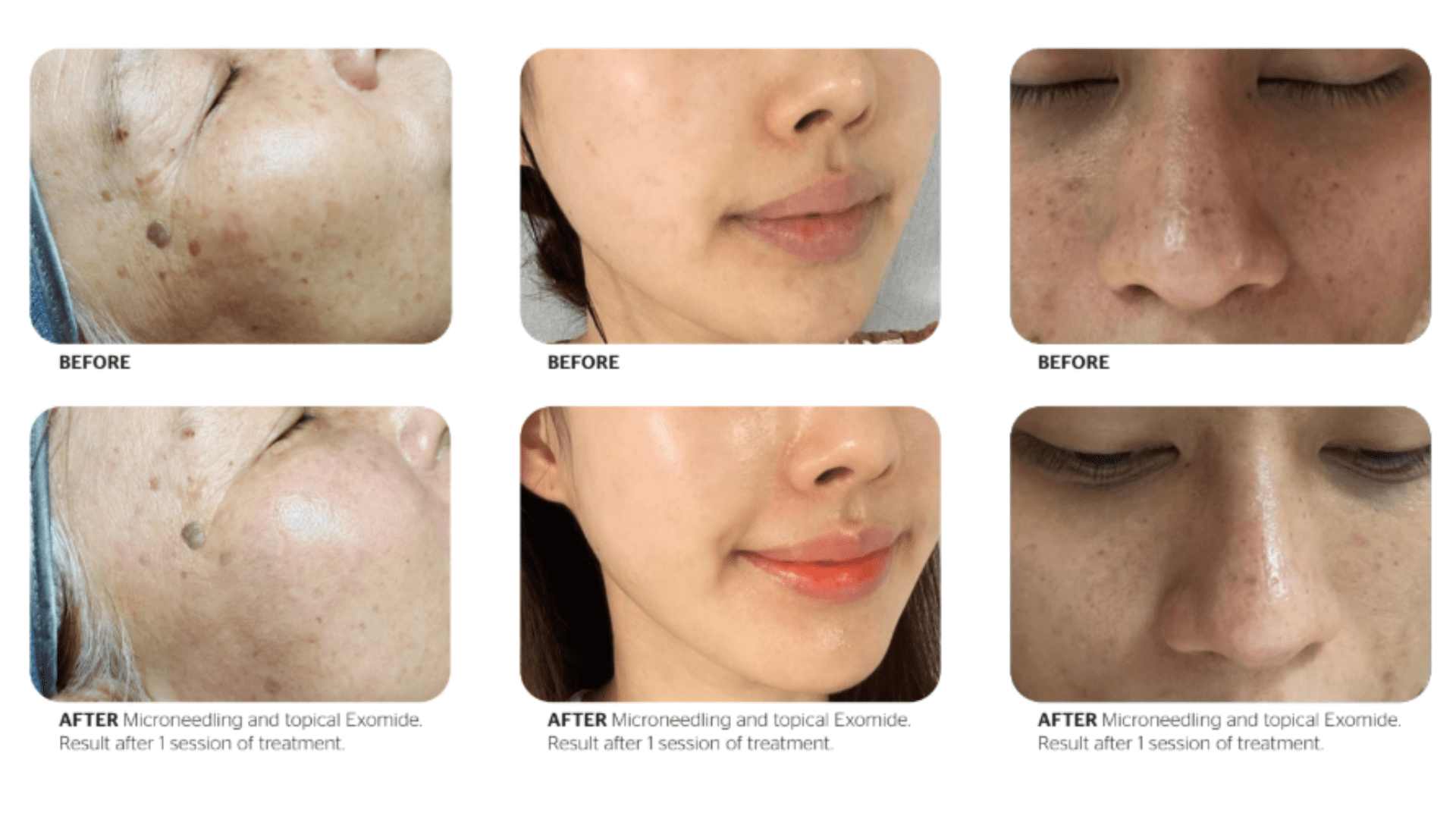 Before And After Just One Session