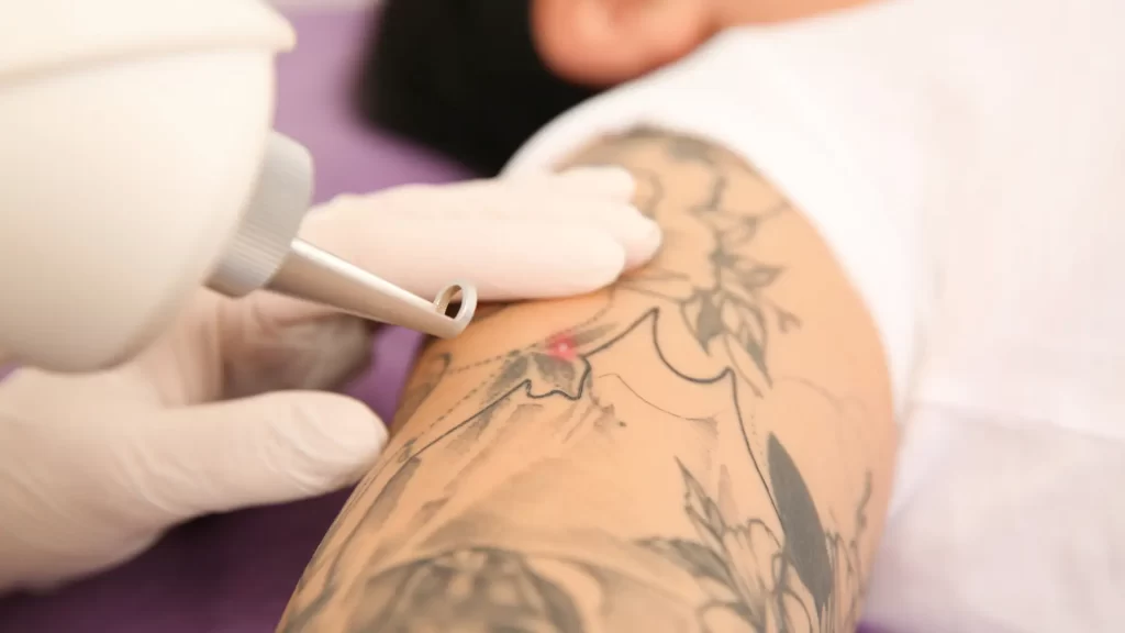 Is Tattoo Removal Painful