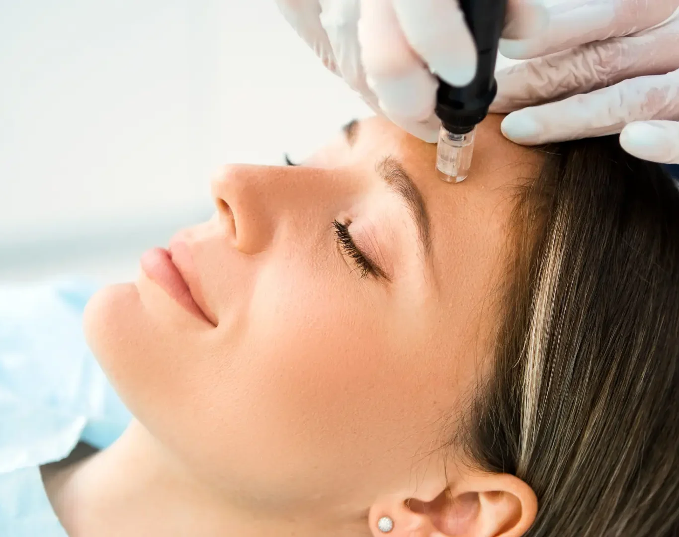 skin needling benefits