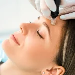 skin needling benefits