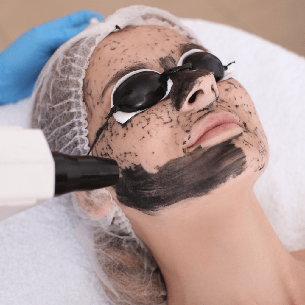 Carbon facials