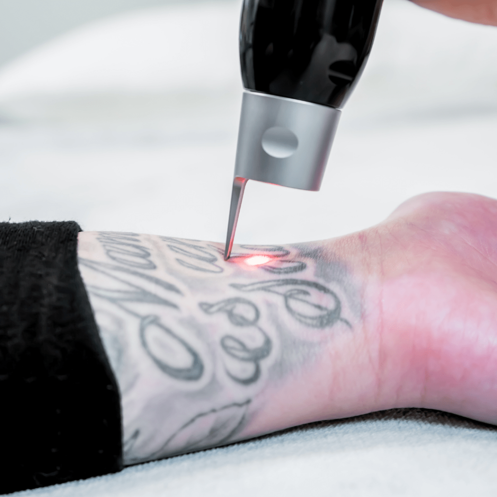 Tattoo Removal